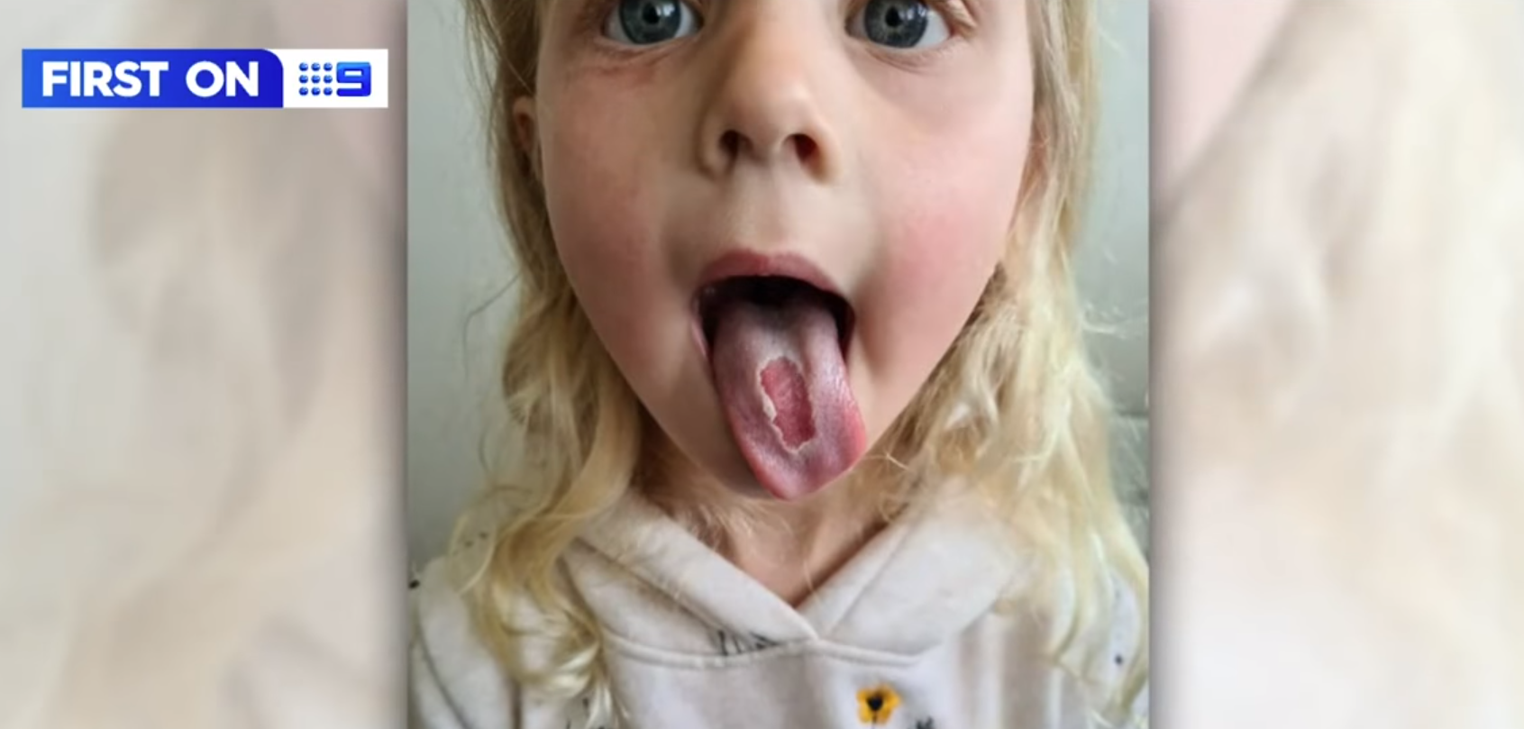 舌頭逐漸康復但仍可見嚴重脫皮。(互聯網)