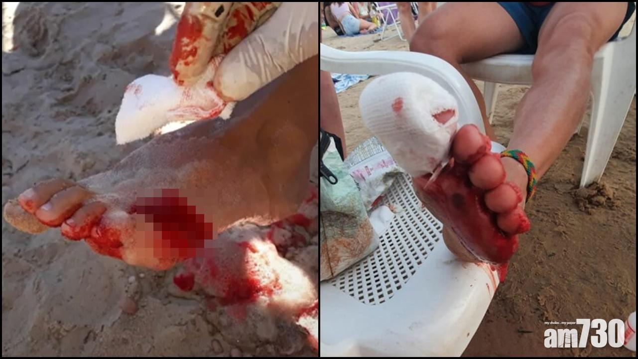 一位男泳客的腳掌有多處傷口,血肉模糊。(網上圖片)