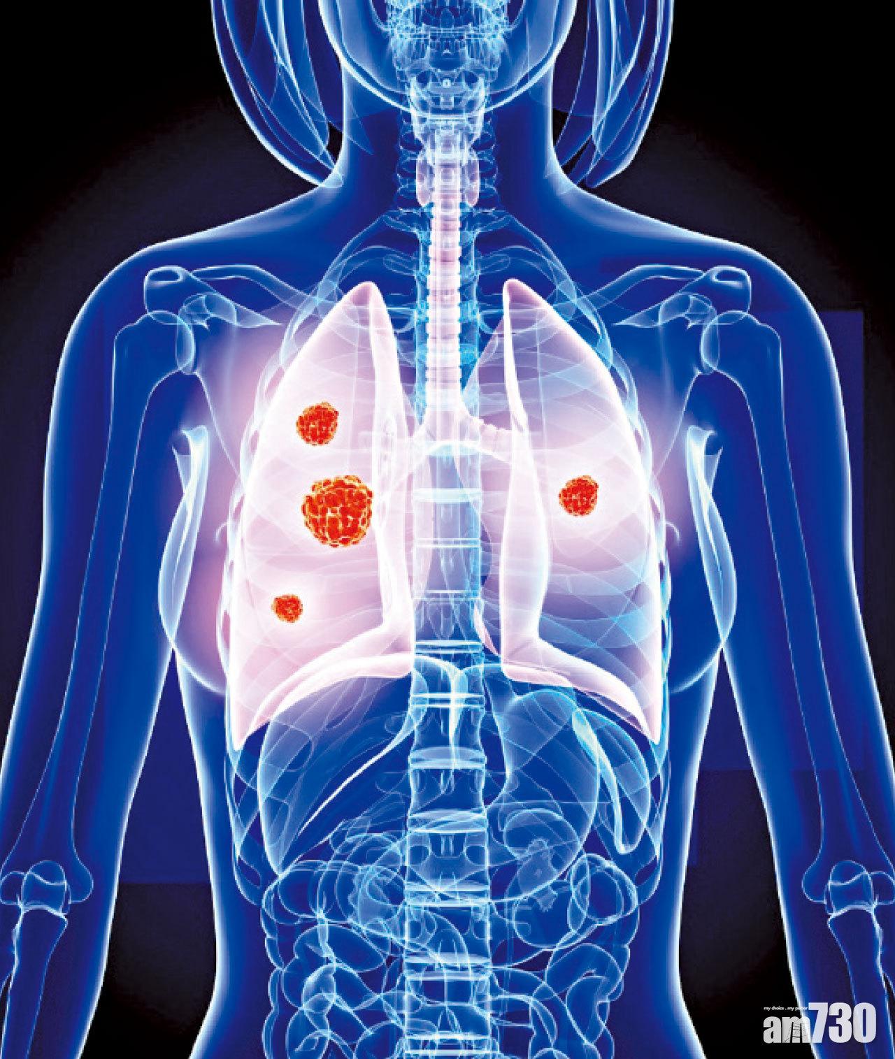 非吸煙者肺癌發病率一直上升,亞洲女性肺癌患者中,多達83%為非吸煙人士。