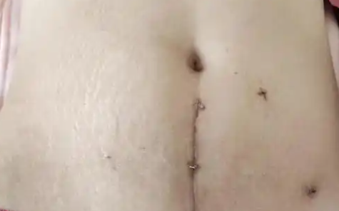 內地人妻做手術取子宮環致十級傷殘 子宮穿孔恐終身再難懷孕