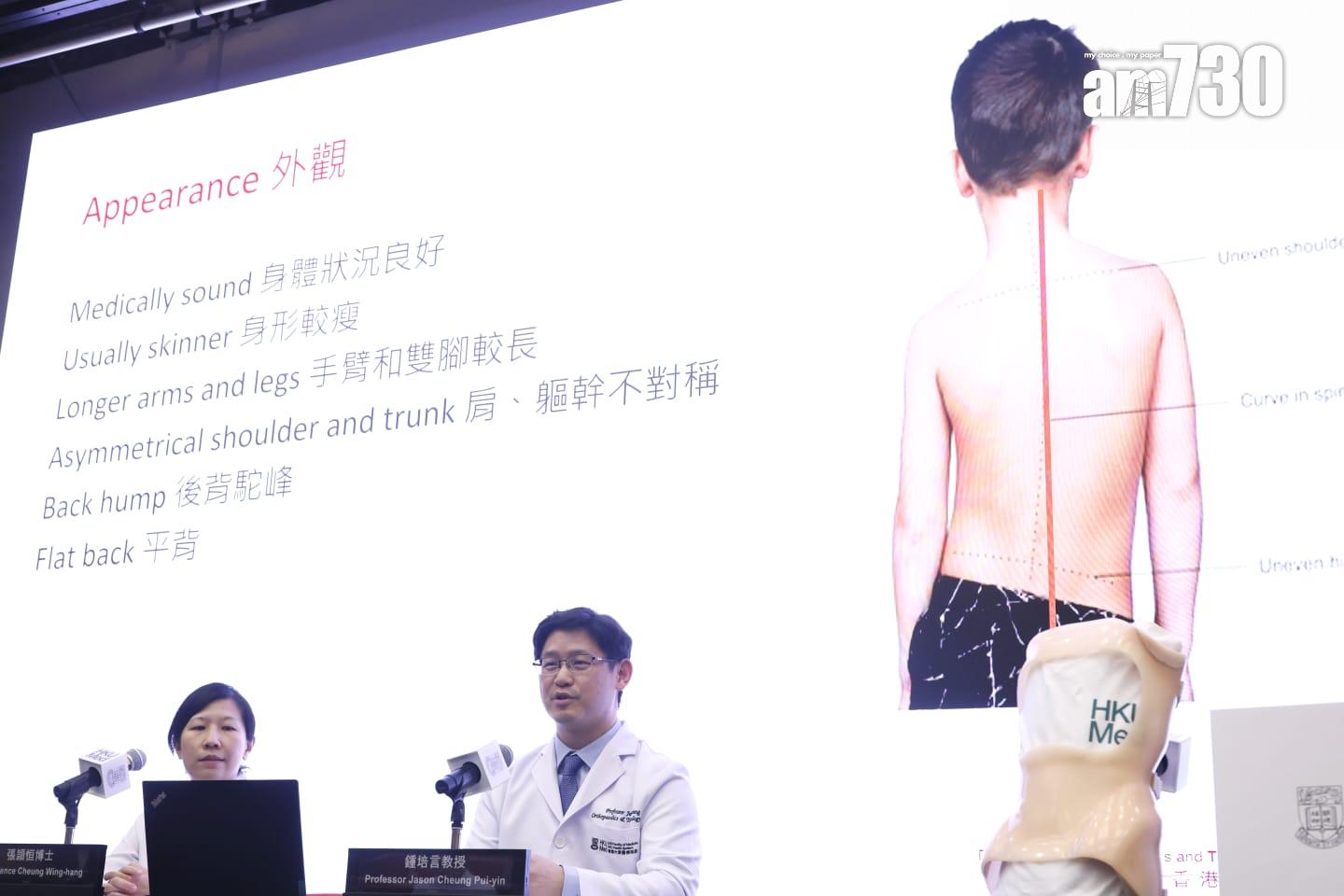 港大研究:青少年原發性脊柱側彎臨床證實,即時停戴矯正器效果佳。(林俊源攝)