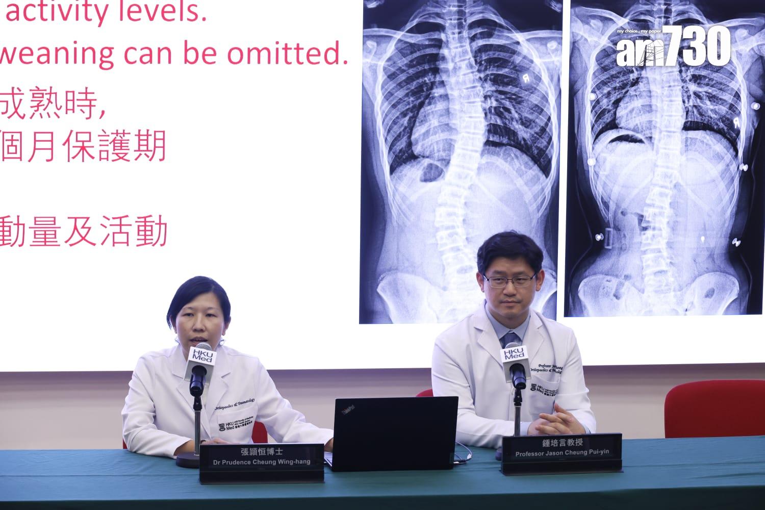 港大研究:青少年原發性脊柱側彎臨床證實,即時停戴矯正器效果佳。(林俊源攝)