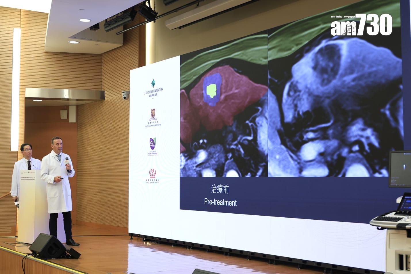 李嘉誠基金會向中文贈送亞洲首台「組織碎化技術」(Histotripsy)2.0系統,治療肝癌患者。(林俊源攝)