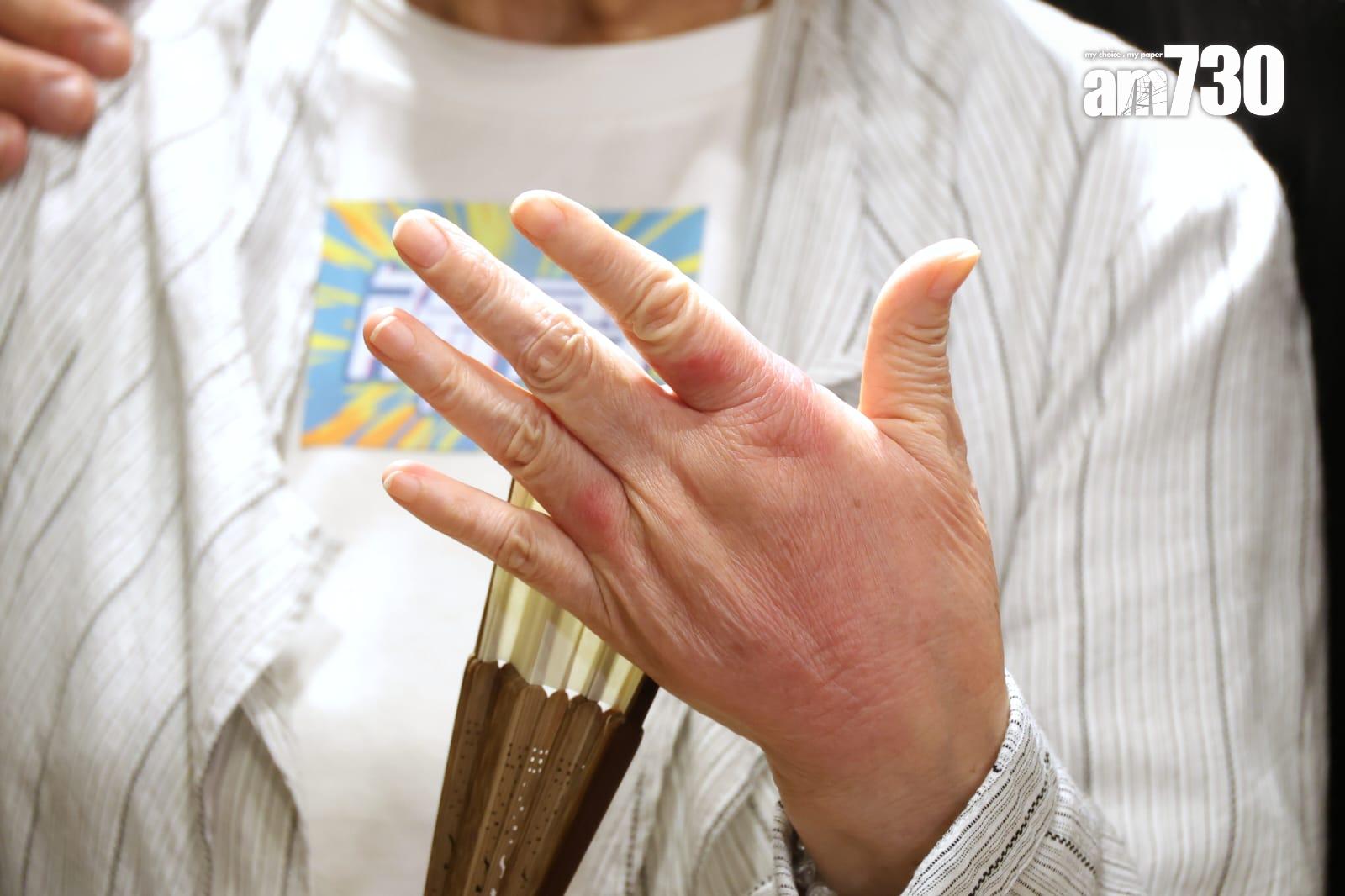 馮素波出席電影《觸電》首映禮,自爆因「為食」致敏感紅腫。(林俊源攝)