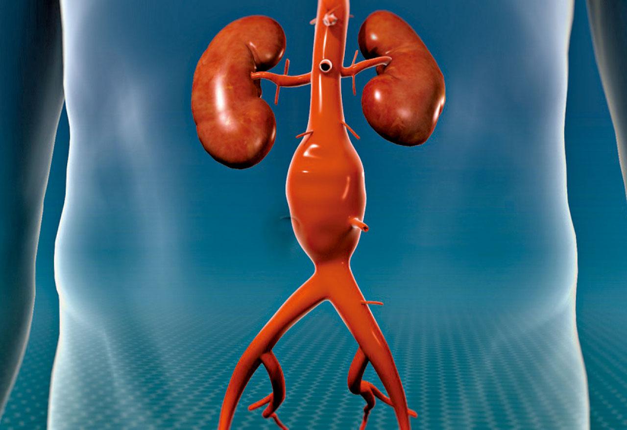 無聲殺手 主動脈瘤