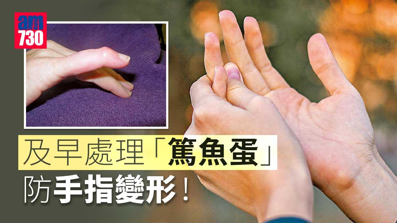 早處理篤魚蛋 防手指變形