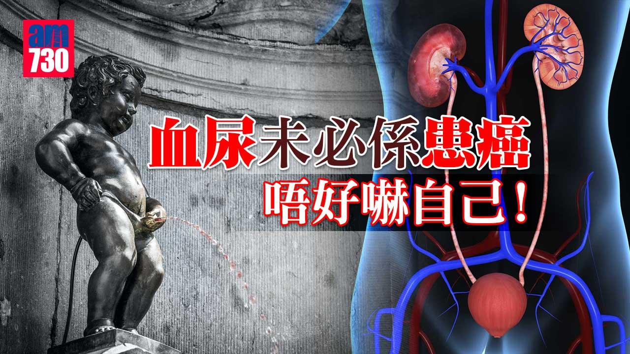 血尿｜唔好嚇自己 未必係患癌