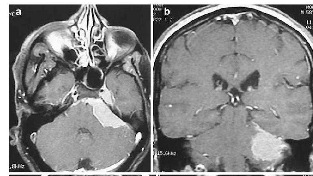 天幕裂孔區腦膜瘤