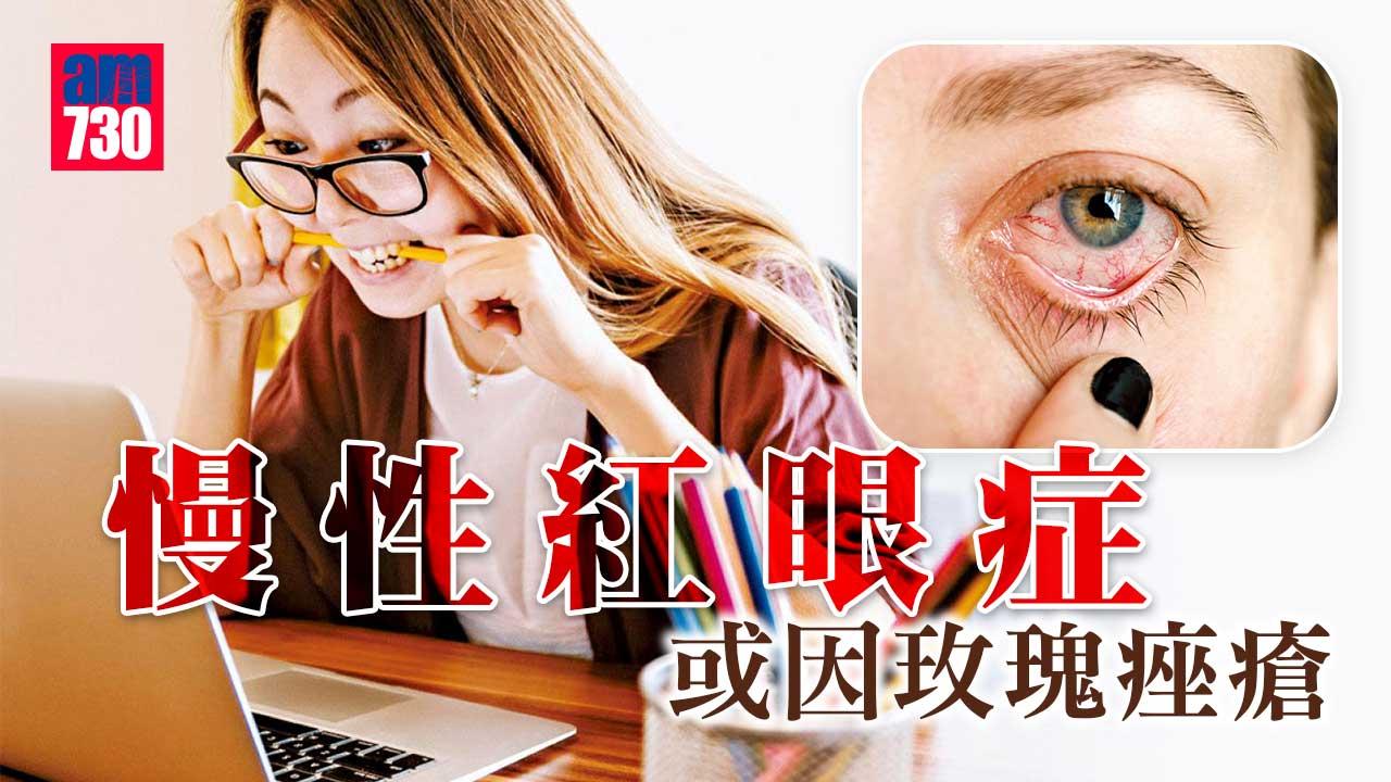 慢性紅眼症 或因玫瑰痤瘡