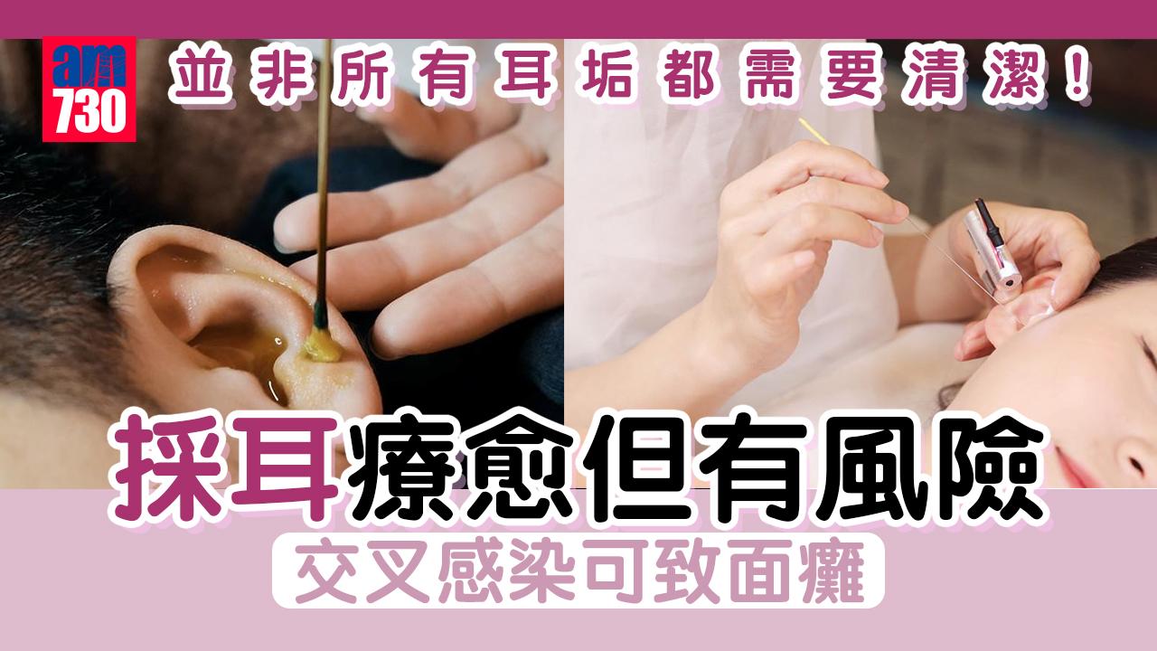 採耳療愈但有風險 受傷發炎可致面癱