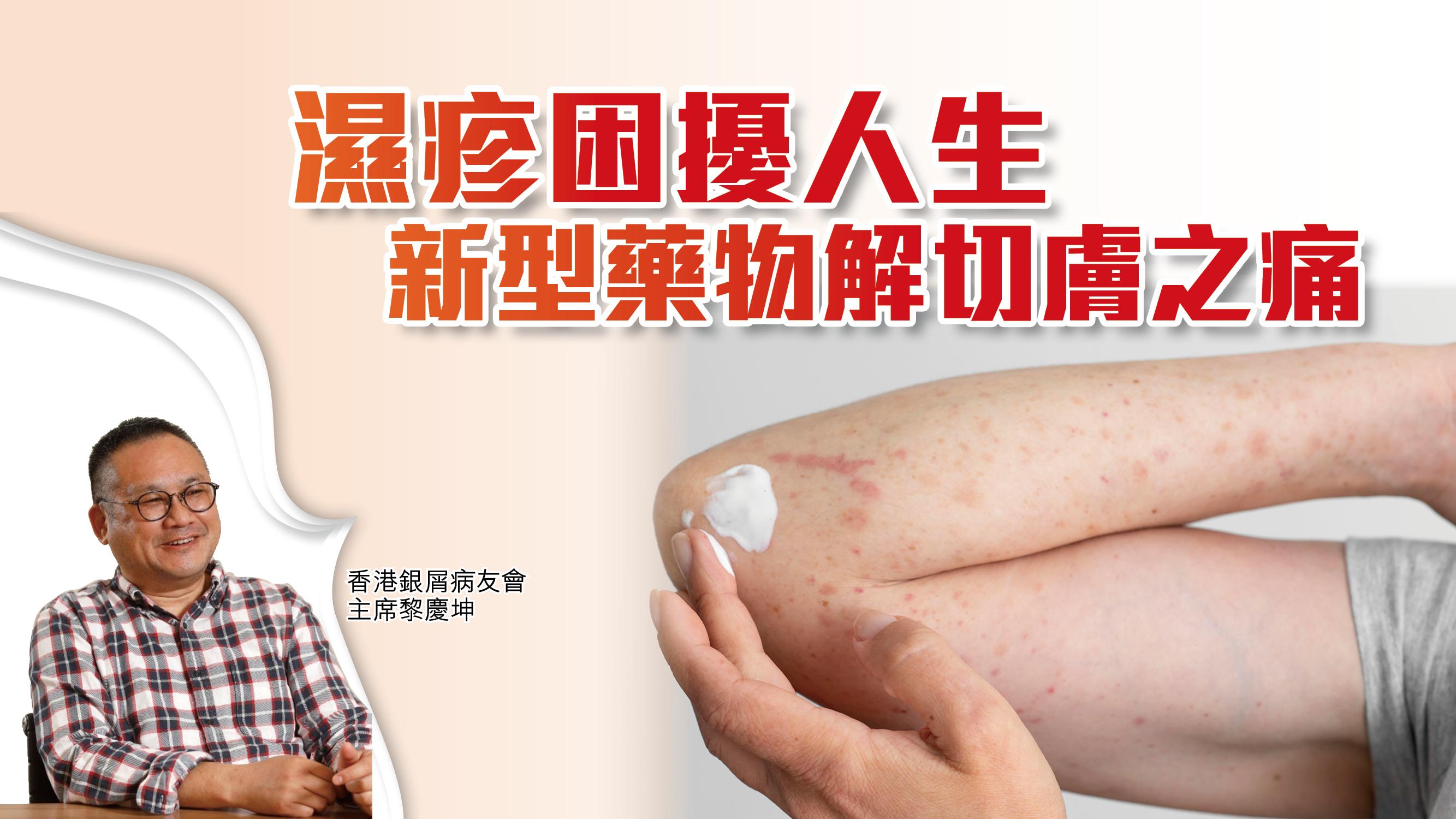 濕疹困擾人生 新型藥物解切膚之痛