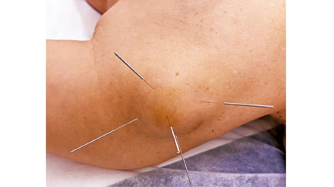 針灸治療脂肪瘤