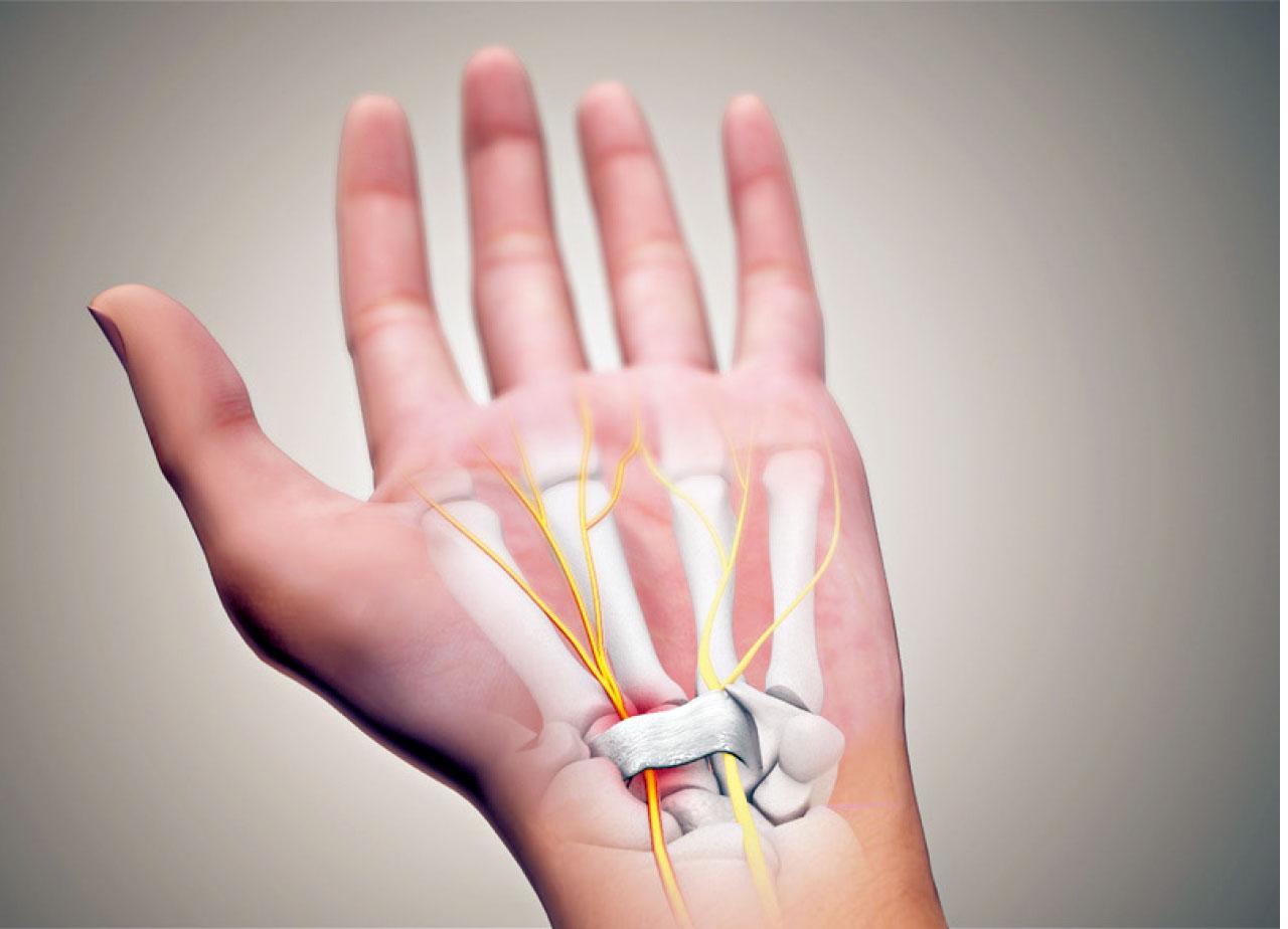 腕管綜合症