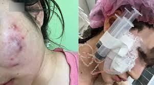 鄭州22歲姓陳女子誤信「一針降顴骨」，結果毀容。(互聯網)