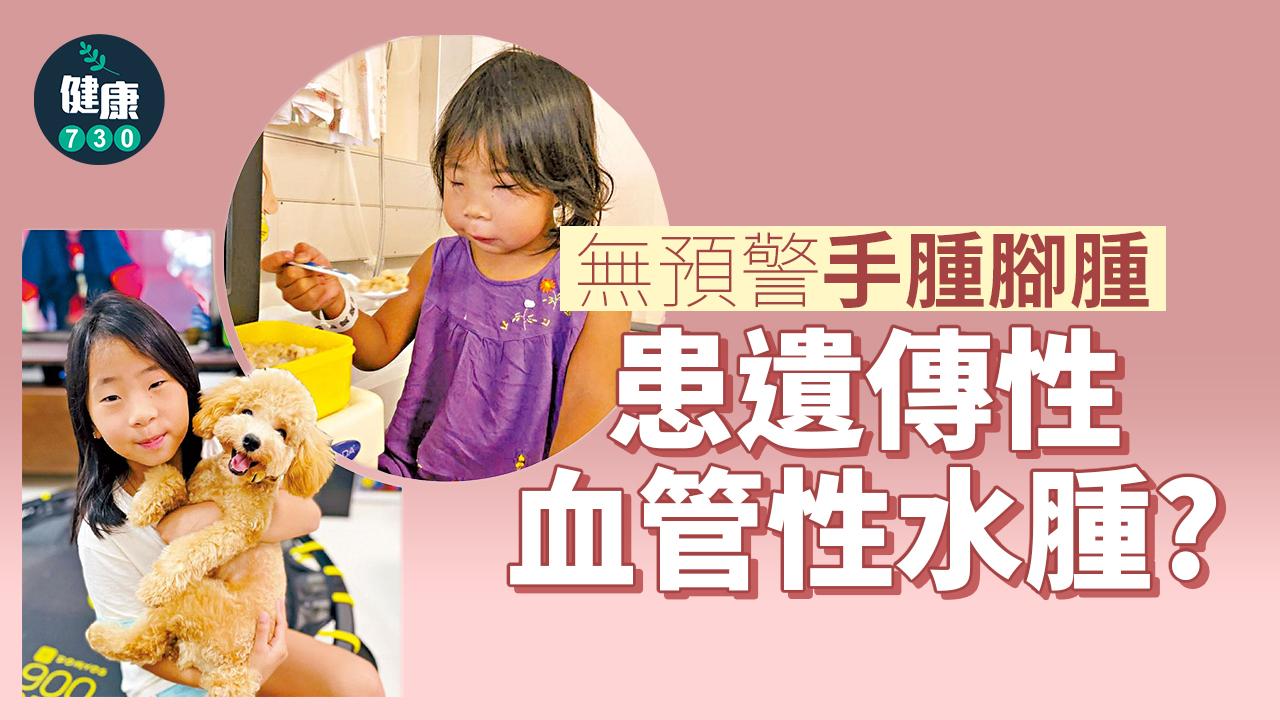 無預警手腫腳腫 患遺傳性血管性水腫？