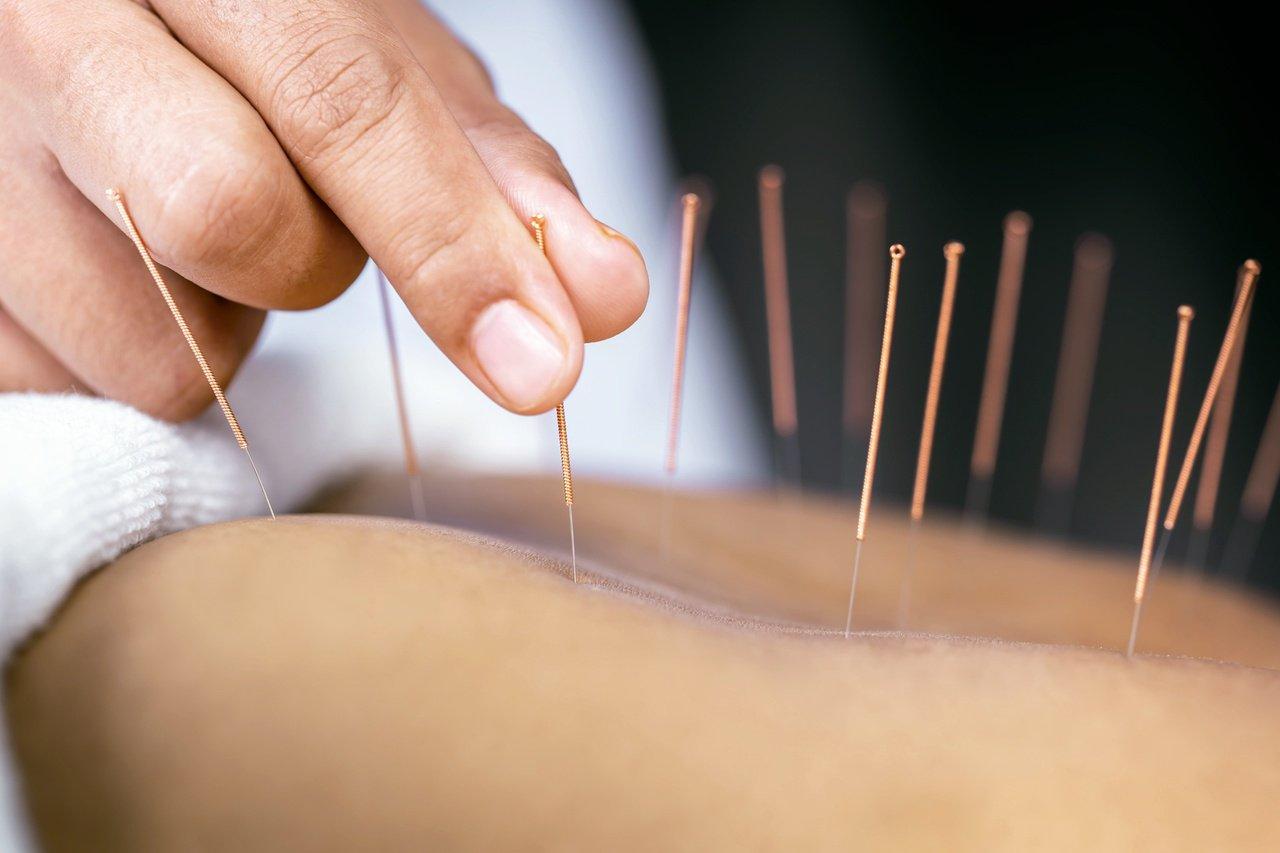 針灸