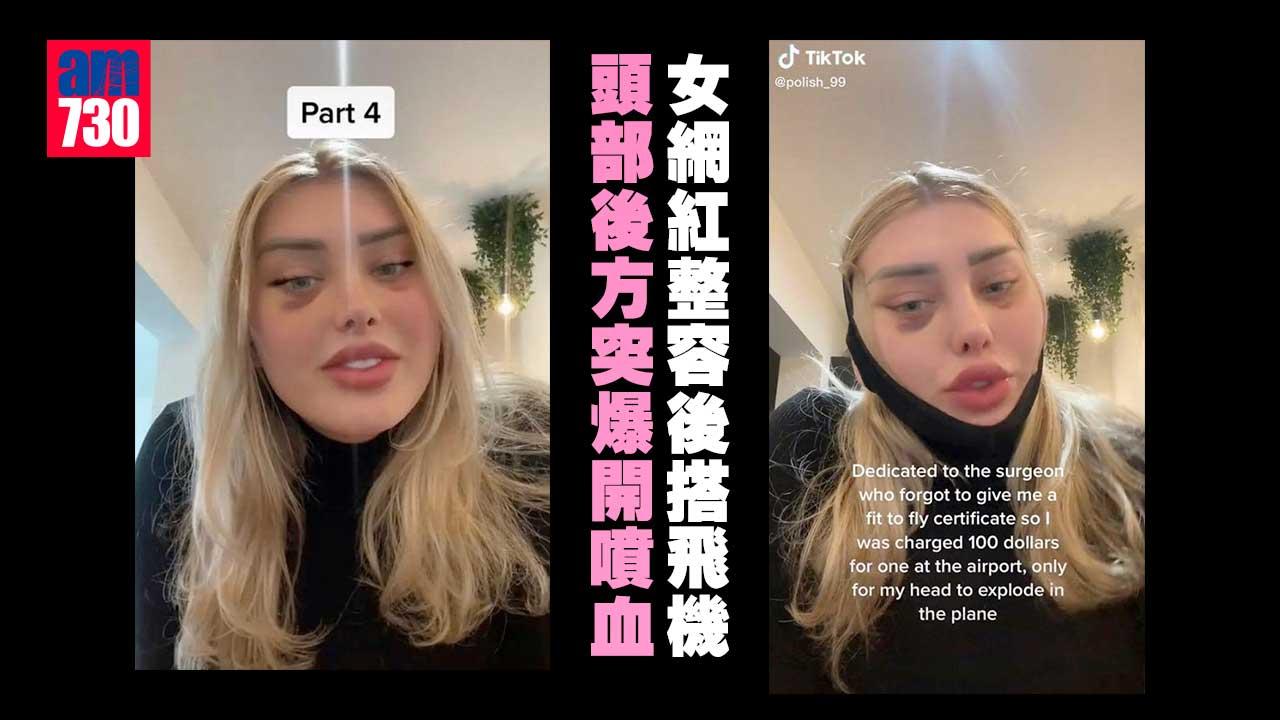 眼部整形手術後即搭機 網紅高空「爆頭」噴血 自揭致傷原因