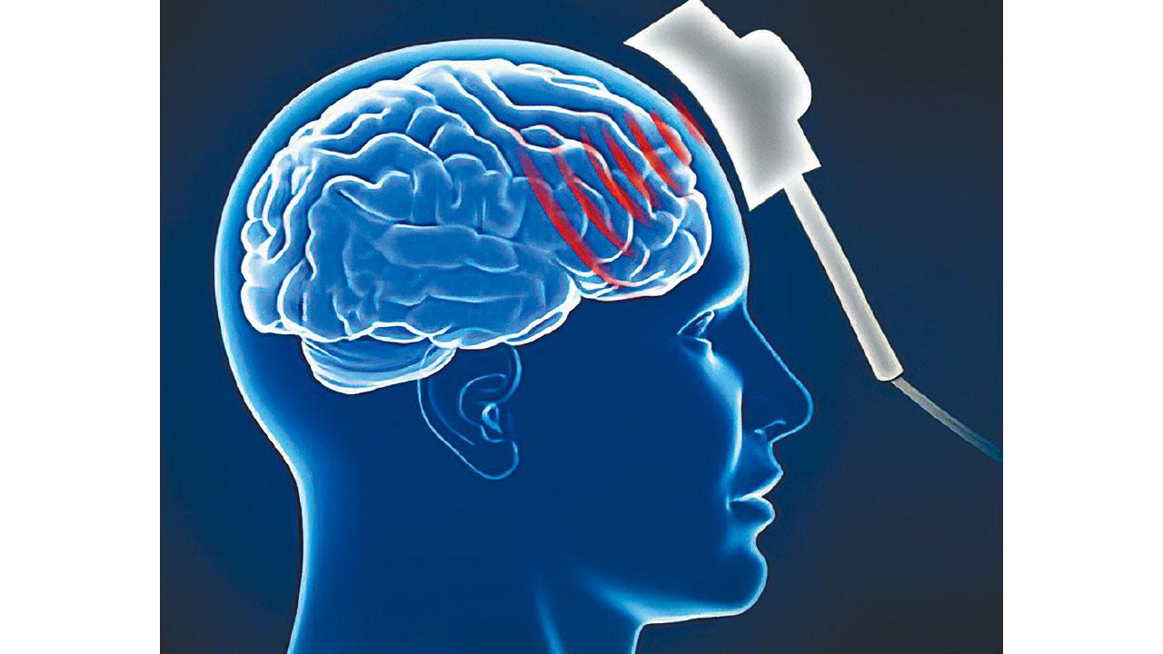 腦磁激治療抑鬱症