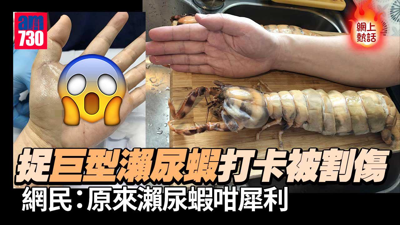網上熱話｜捉巨型瀨尿蝦打卡被割傷 港男手掌留長「蜈蚣」傷口
