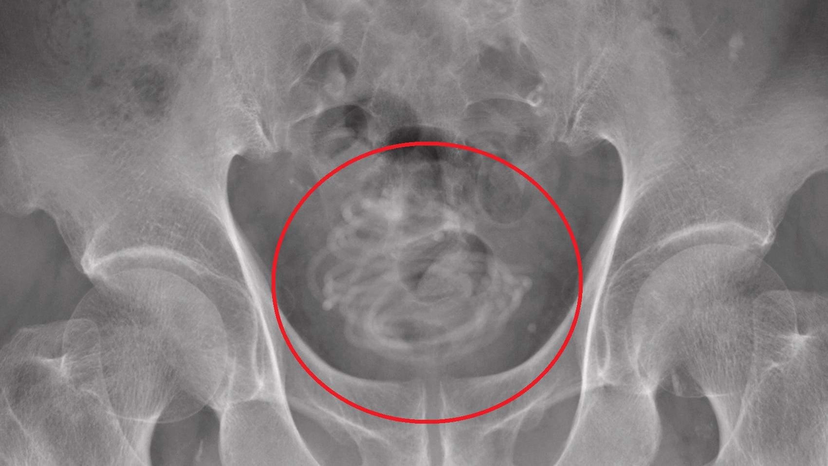 膠製跳繩在老翁膀胱裡纏成一團。(互聯網)