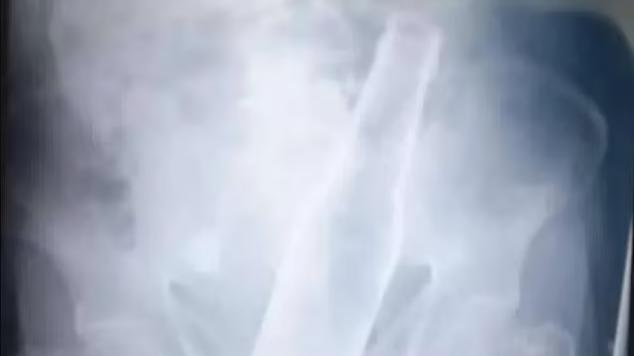 X光顯示，啤酒樽卡在老翁下腹。(互聯網)