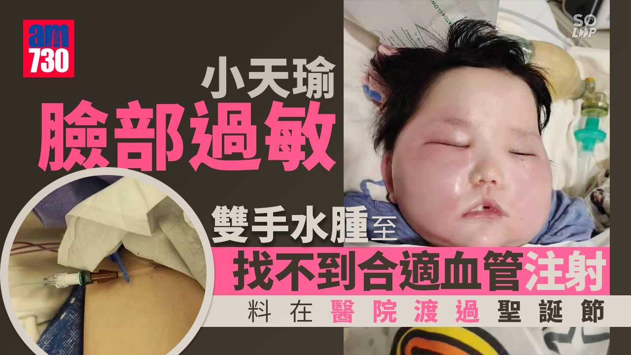 小天瑜臉部過敏紅腫再入NICU治療　料聖誕節在醫院渡過