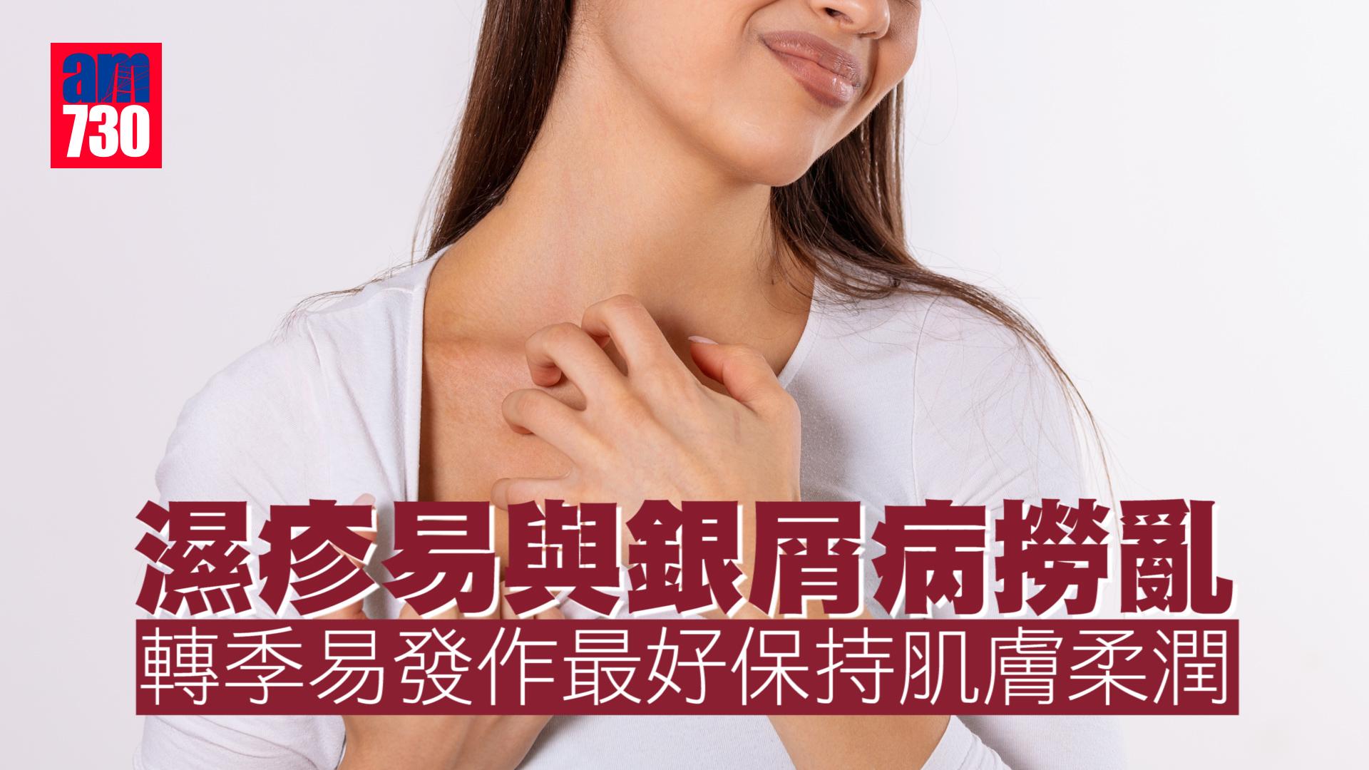 濕疹易與銀屑病撈亂 轉季易發作最好保持肌膚柔潤