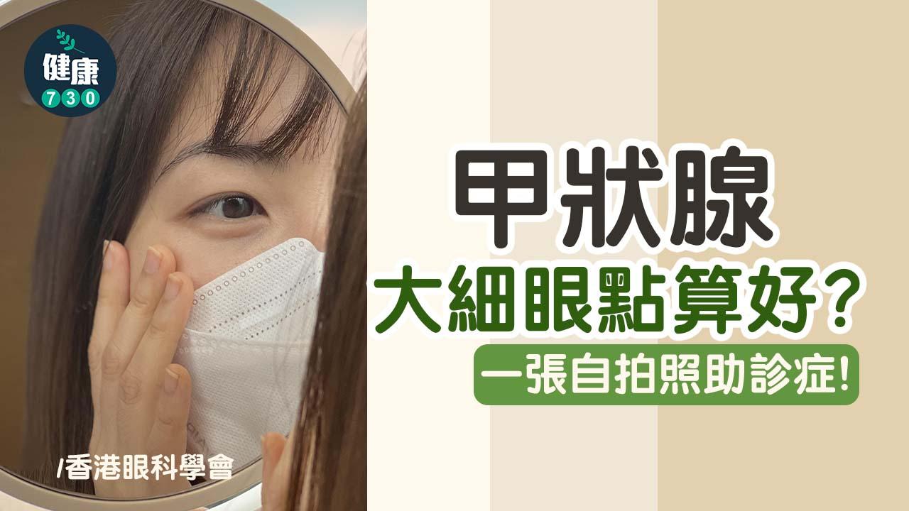 甲狀腺大細眼點算好？一張自拍照助診症！