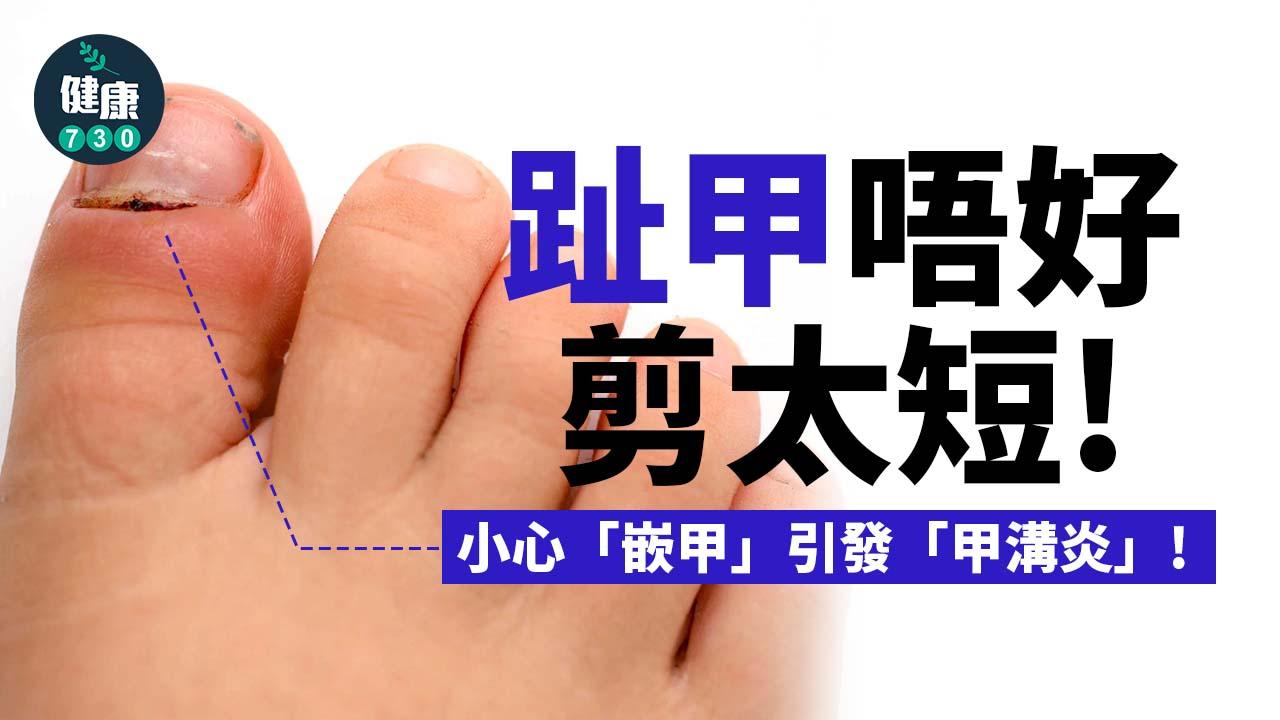 腳趾甲剪太短小心「嵌甲」！ 