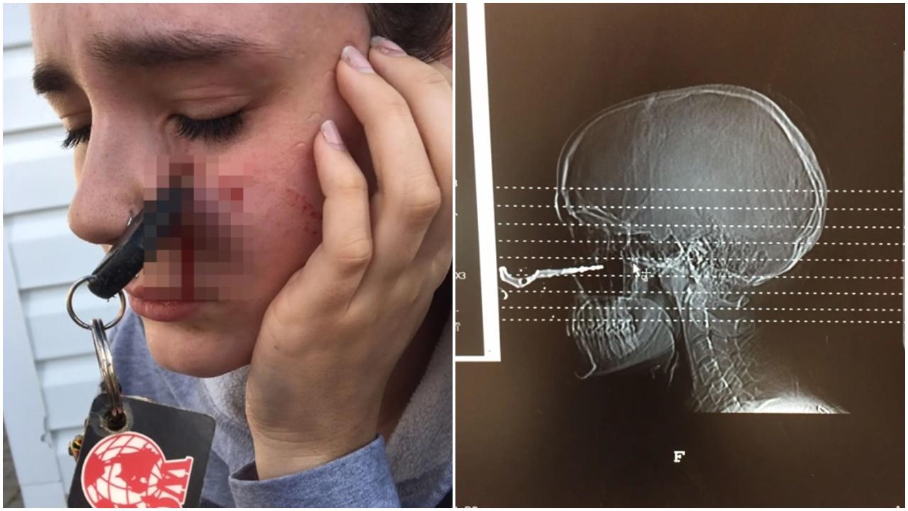 朋友隨手擲車匙，竟插入少女面險盲。(YouTube)