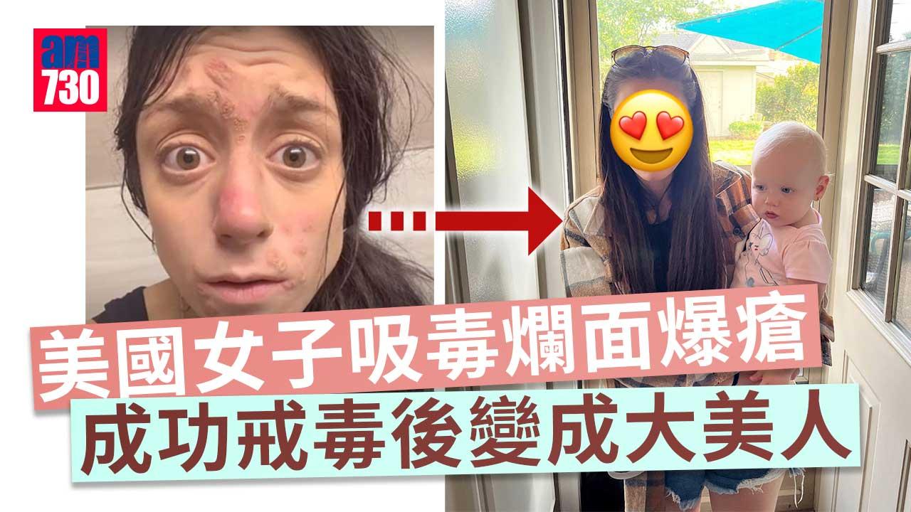 勵志故事｜27歲女吸毒爛面爆瘡　戒毒3年後靚爆鏡(有片)