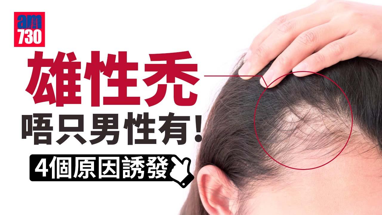 雄性禿唔只男性有！原來係呢4個原因引致