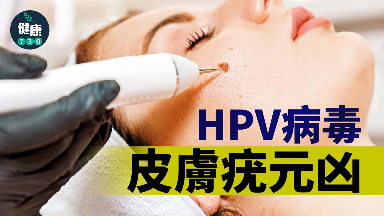 HPV病毒 皮膚疣元凶