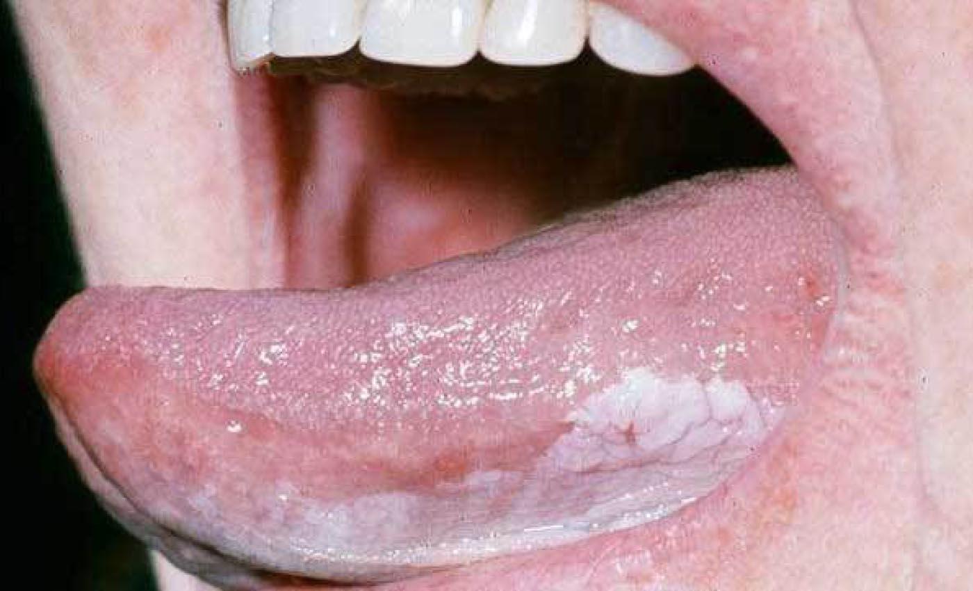 口腔黏膜白斑症