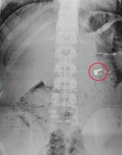 巴西3童黨搶劫遊客被捕卻不見贓物，原來金鏈藏在這裡。(網上圖片)