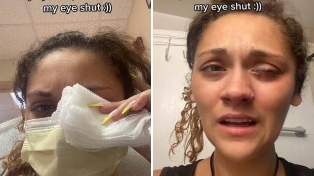 莉德哭訴被強力膠黏眼，很痛苦。(互聯網)