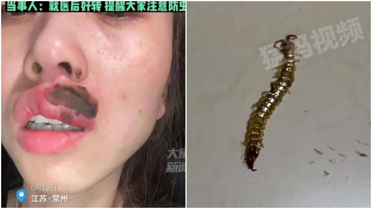 江蘇女半夜被蜈蚣「錫」醒，咀唇麻痺變潤腸。(微博)