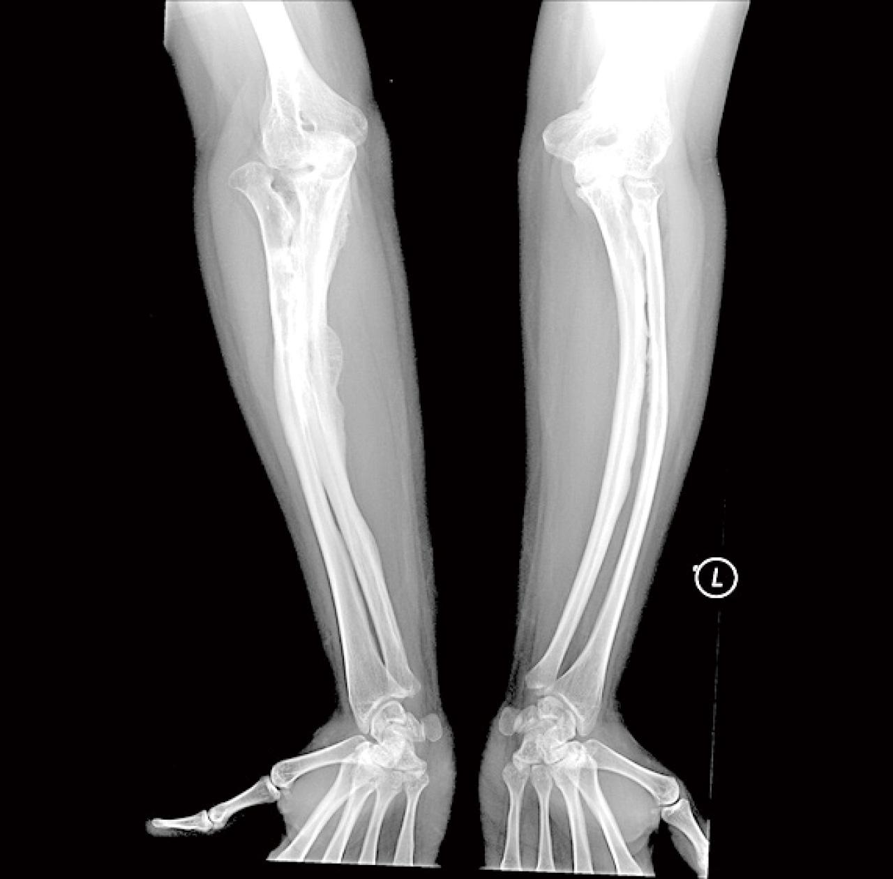 成骨不全症的多學科管理