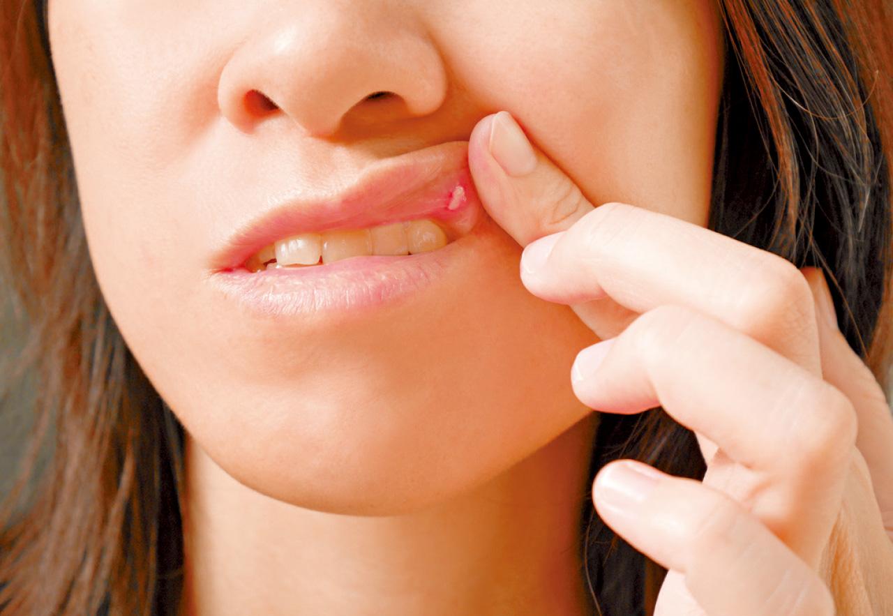 中醫治療口腔潰瘍