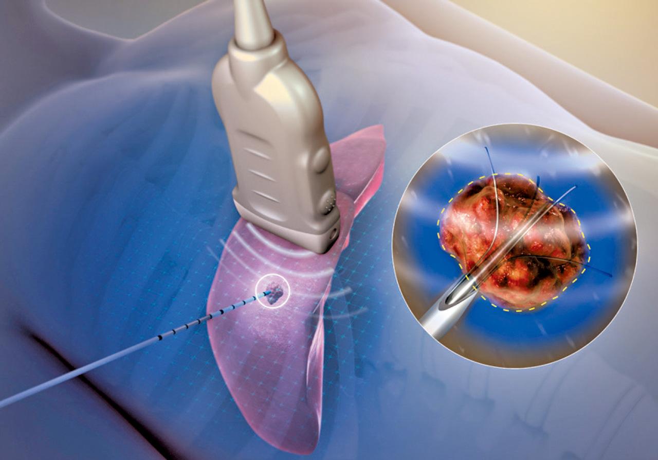 開刀以外 肝癌消融療法 