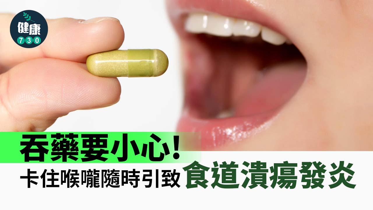 吞藥要小心 卡住喉嚨隨時引致食道潰瘍發炎