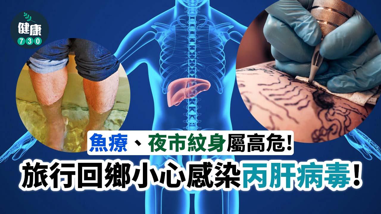 旅行回鄉 小心感染丙肝病毒