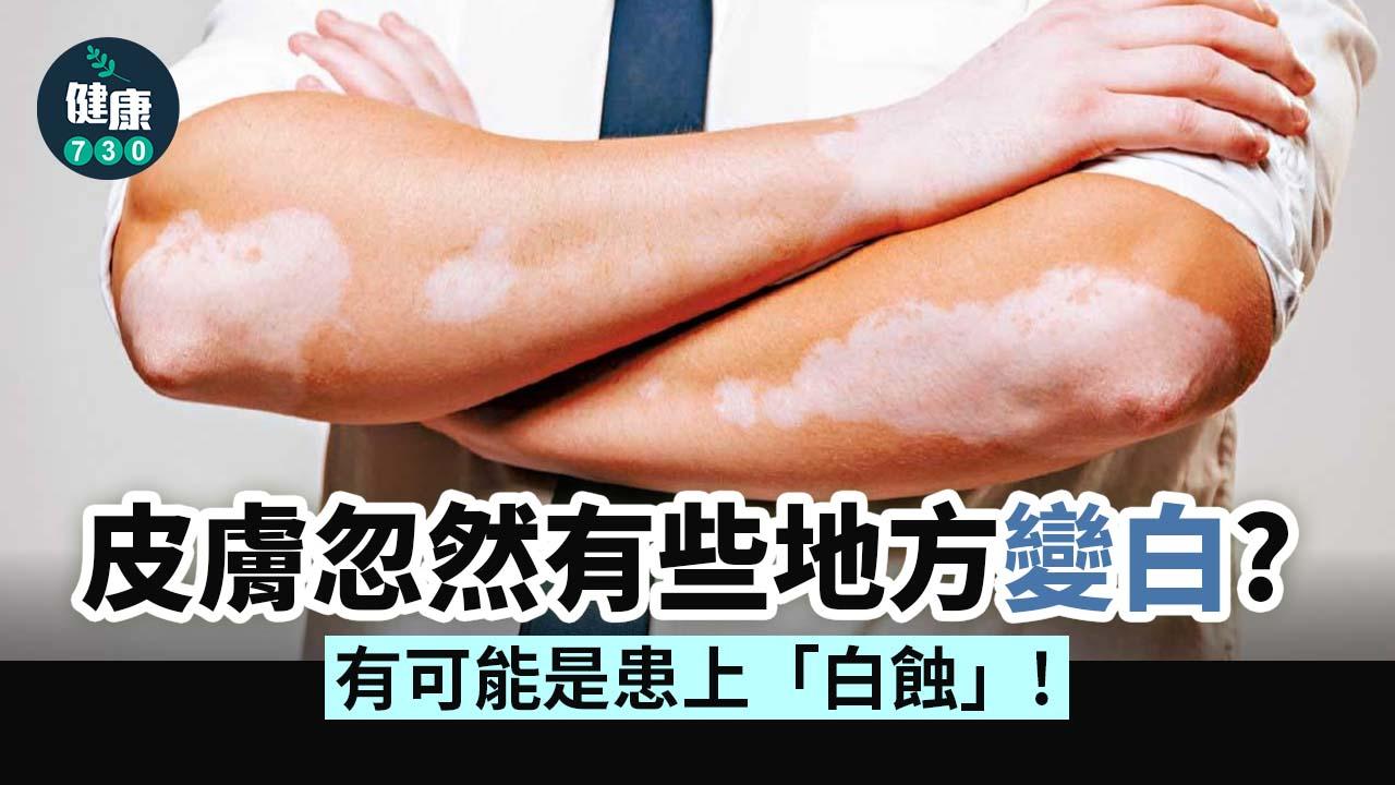 皮膚突現奶白斑塊 或患白蝕