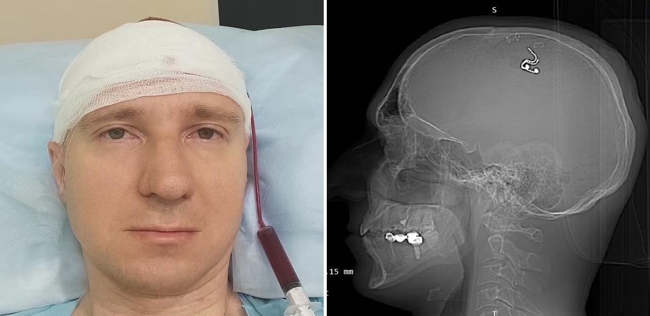 拉杜加自己開腦在頭頂植入晶片，希望像《潛行凶間》的主角能控制夢境。(互聯網)