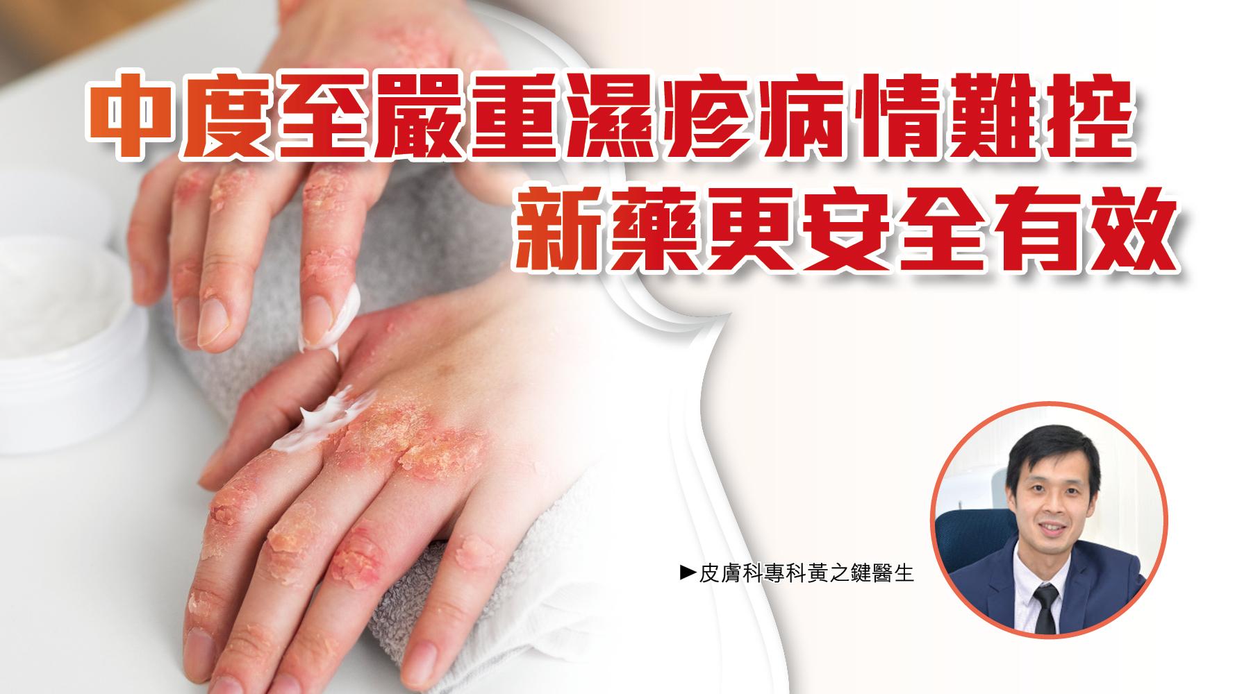 中度至嚴重濕疹病情難控 新藥更安全有效