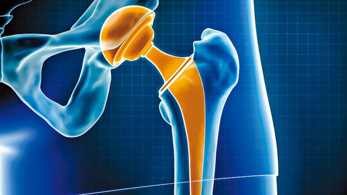 機械臂輔助手術好處多(一) 置換髖關節置換