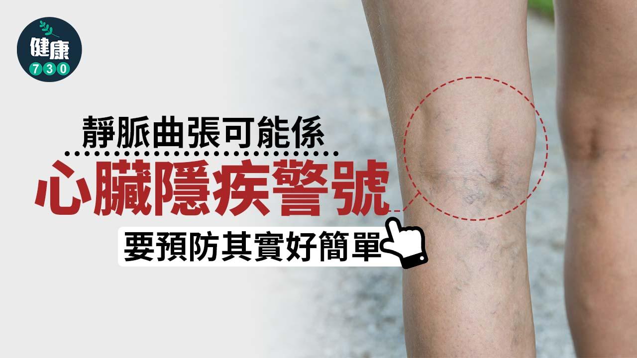 靜脈曲張可能係心臟隱疾警號　要預防其實好簡單