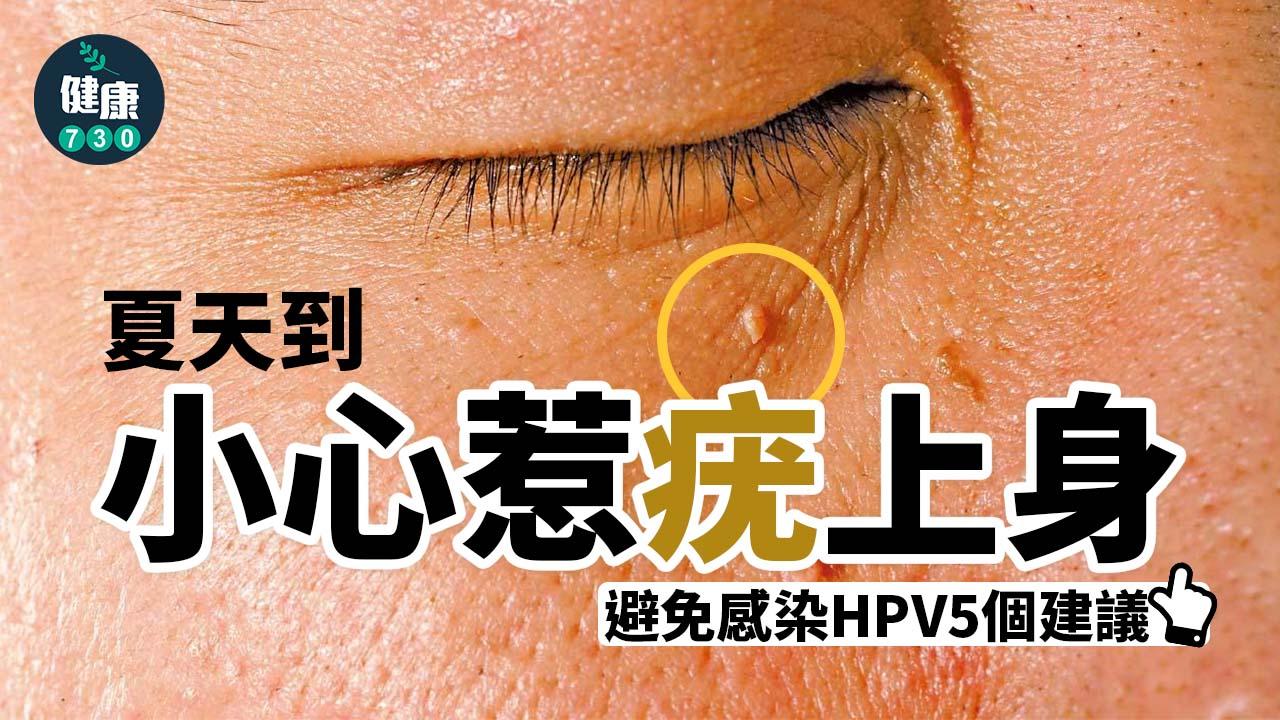 皮膚病｜夏天到 小心惹疣上身