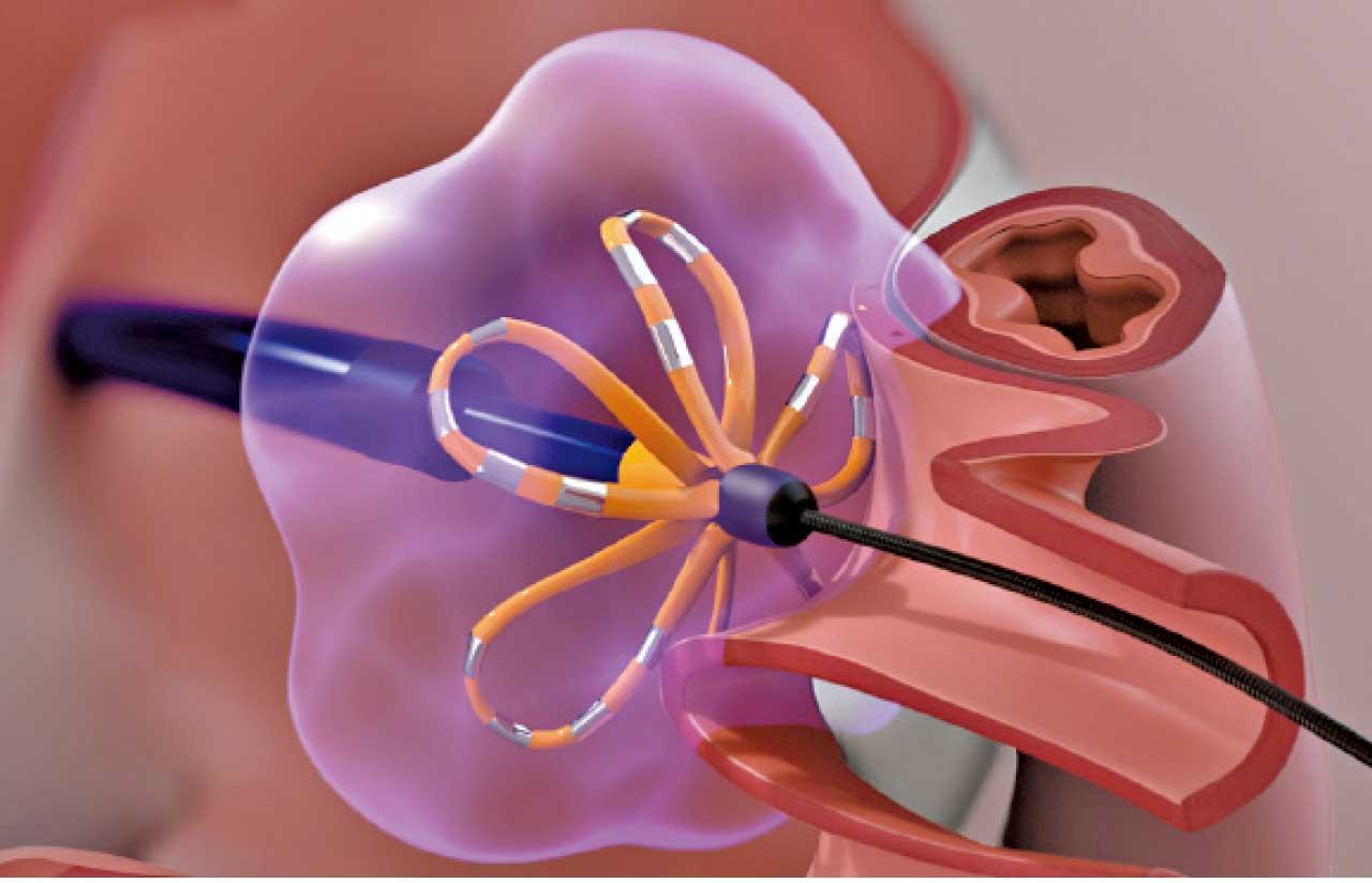 脈衝場消融術 遏止心房顫動