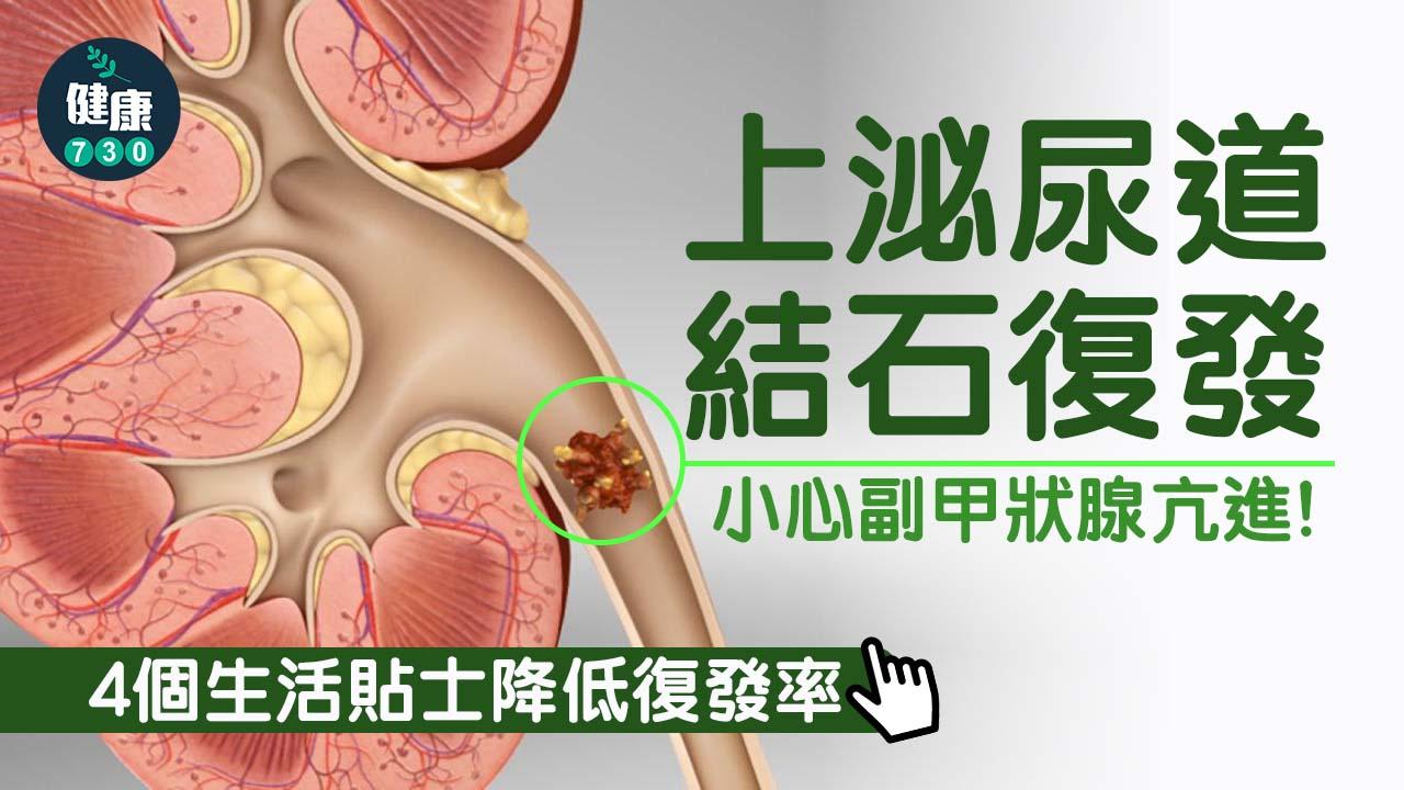 上泌尿道結石復發 小心副甲狀腺亢進！附生活貼士減低復發率